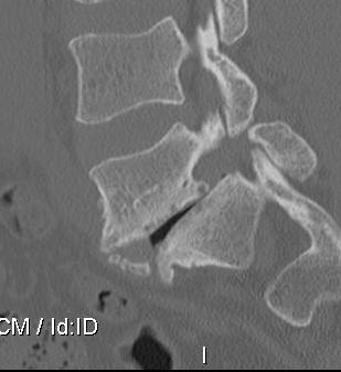 Spondylithesis L5 S1 with disc degeneration